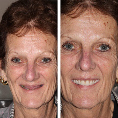 Patient before and after comprehensive smile restoration