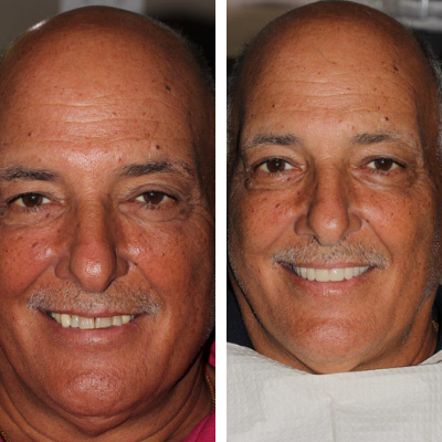 Patient before and after full-arch implant treatment