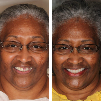 Patient before and after cosmetic restoration