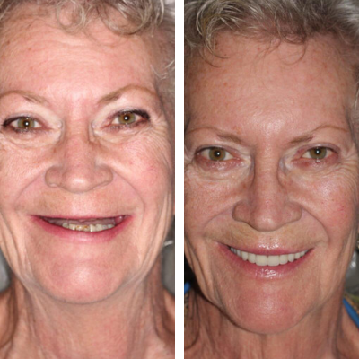Patient before and after full smile transformation