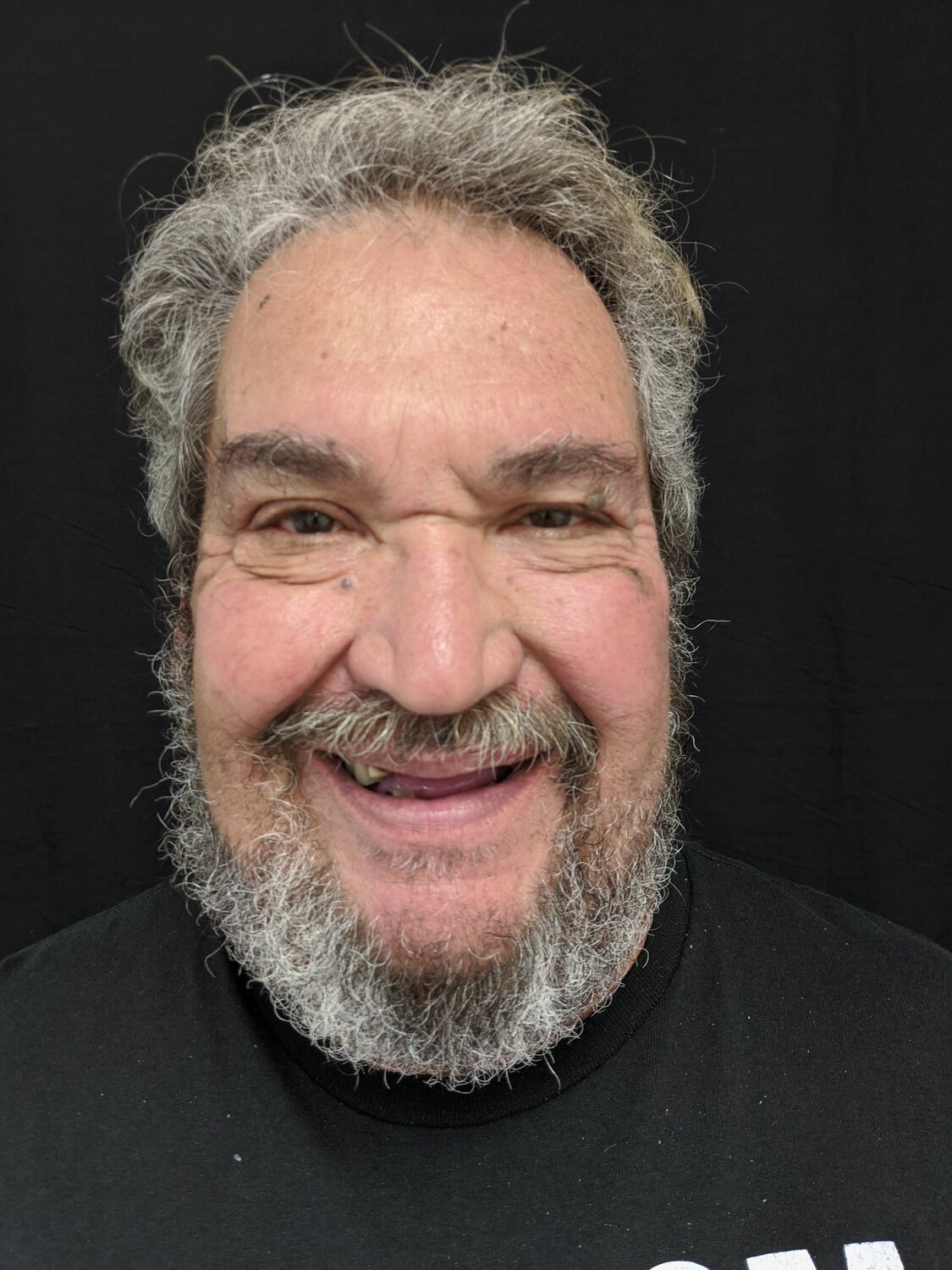 Michael before full-mouth implant restoration with Dr. Rauch